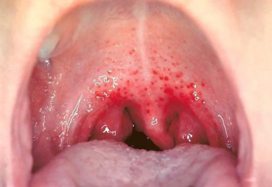 Red Spots in the Mouth  How to Treat Red Spots on Roof of Mouth